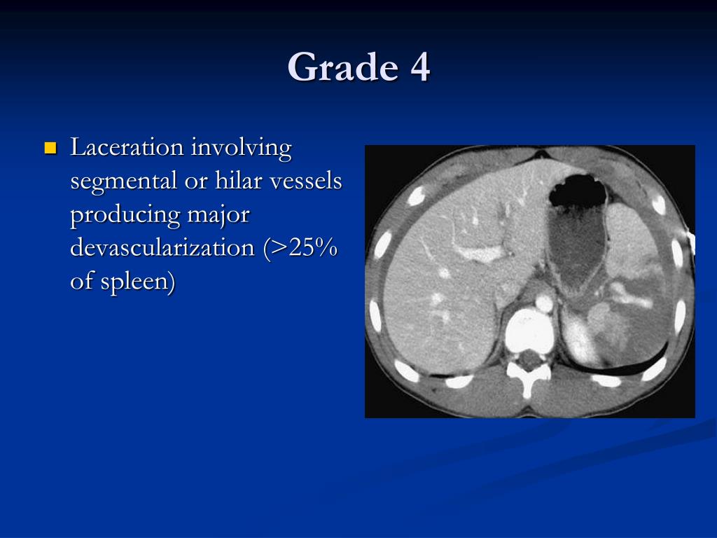 PPT JHSGR Management of blunt splenic injuries PowerPoint