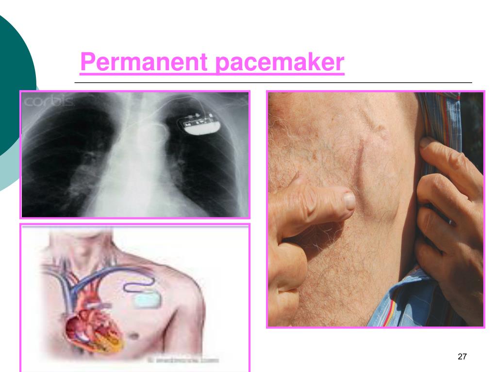 PPT CARDIAC PACING PowerPoint Presentation, free download ID471169