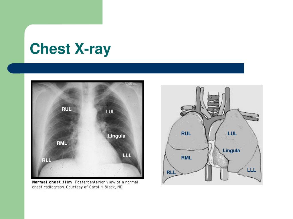 PPT Pneumonia PowerPoint Presentation, free download