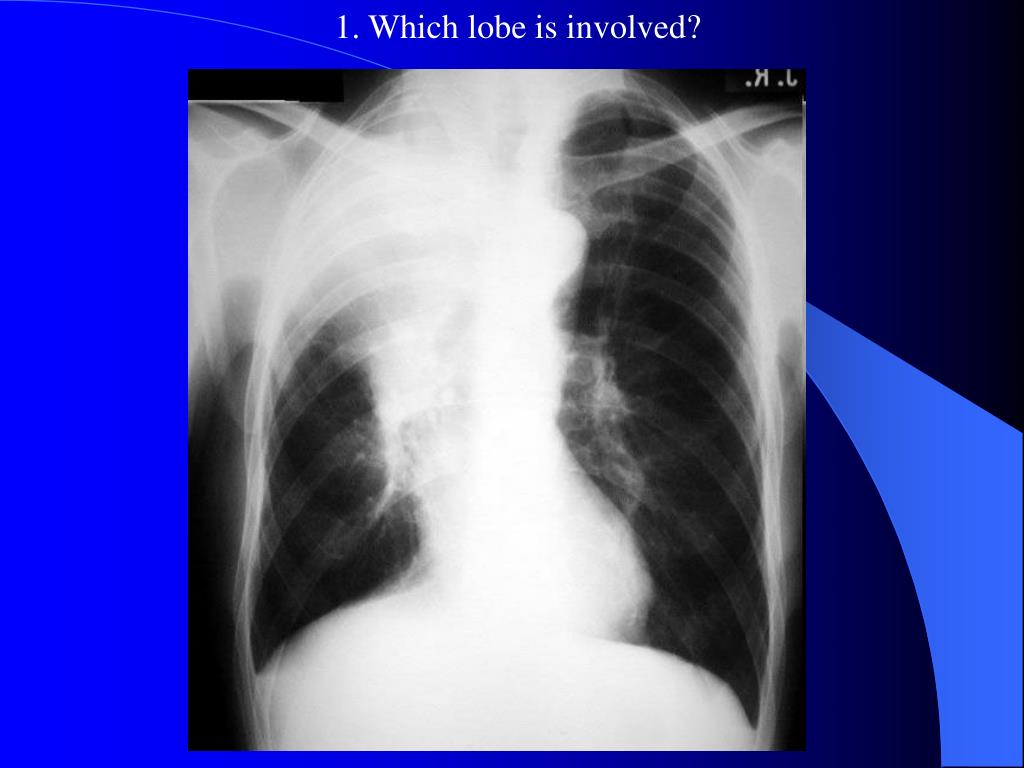 PPT Chest Xray Interpretation Quiz PowerPoint Presentation, free