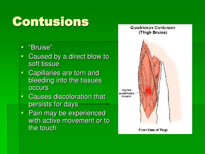 PPT Chapter 13 Recognizing Different Sports Injuries PowerPoint