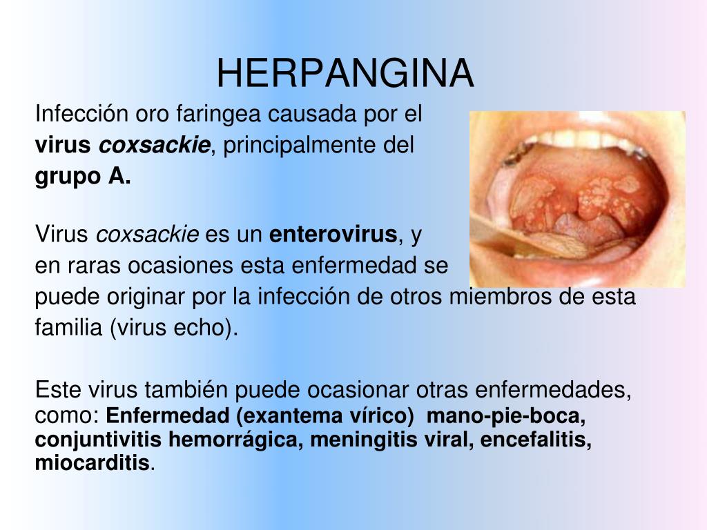 PPT Amigdalitis y Herpangina PowerPoint Presentation, free download