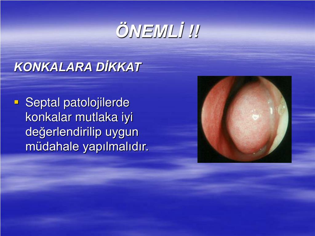 PPT SEPTOPLASTİ PowerPoint Presentation, free download ID490164
