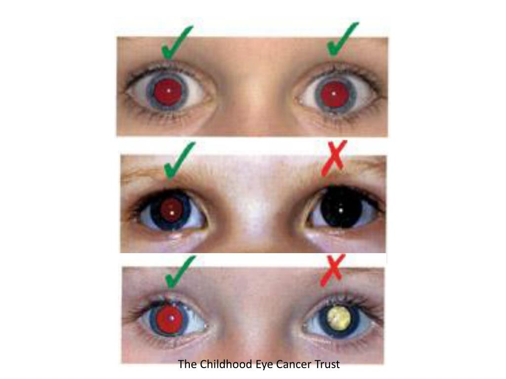 PPT Paediatric Ophthalmology Community to the hospital PowerPoint