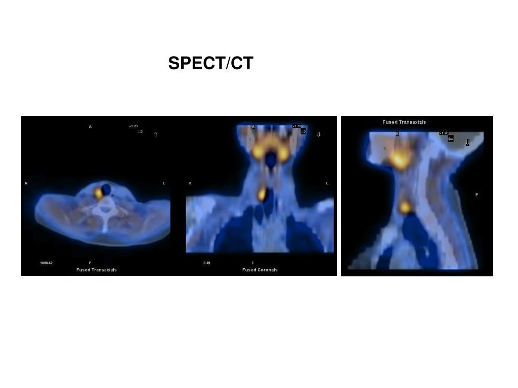 PPT NUCLEAR MEDICINE IMAGING OF PARATHYROID PowerPoint Presentation