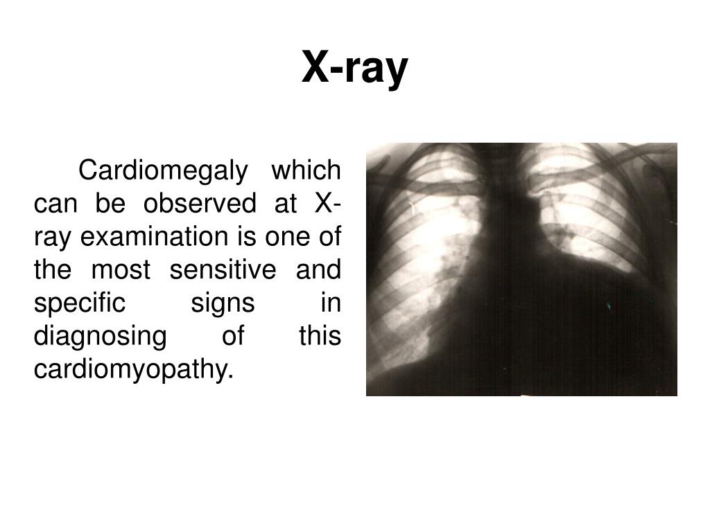 PPT Myocardial diseases PowerPoint Presentation, free download ID
