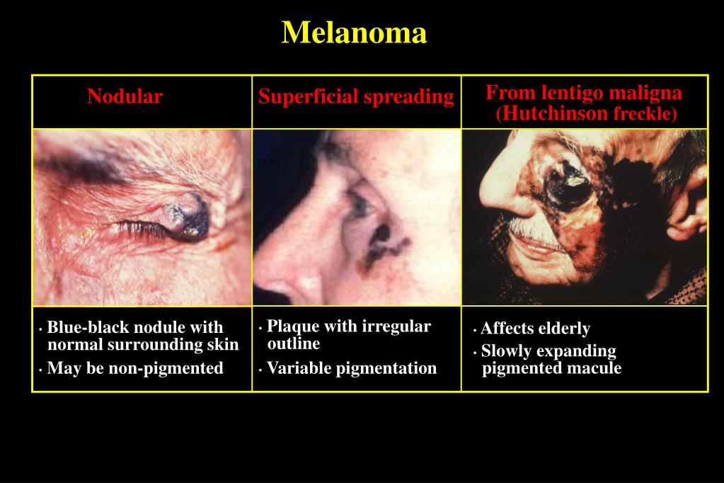 Icd 10 Code For Lentigo Maligna Melanoma