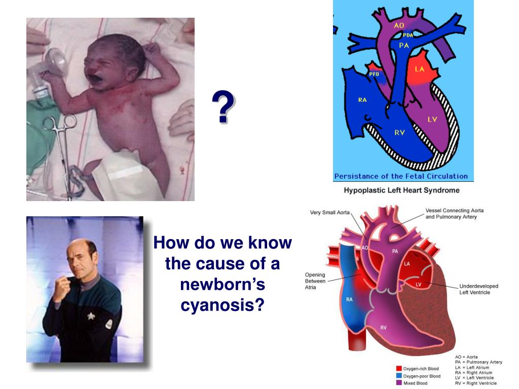 PPT Persistent Pulmonary Hypertension in the Newborn PowerPoint