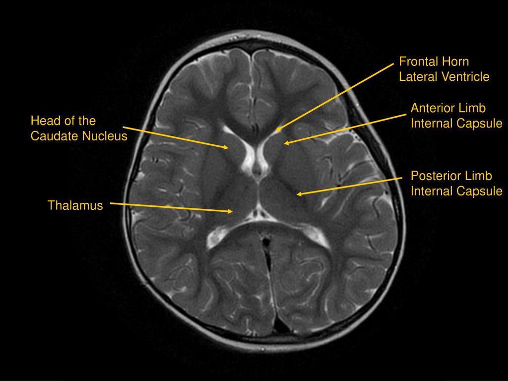 PPT MRI of Brain/Head and Neck PowerPoint Presentation, free download