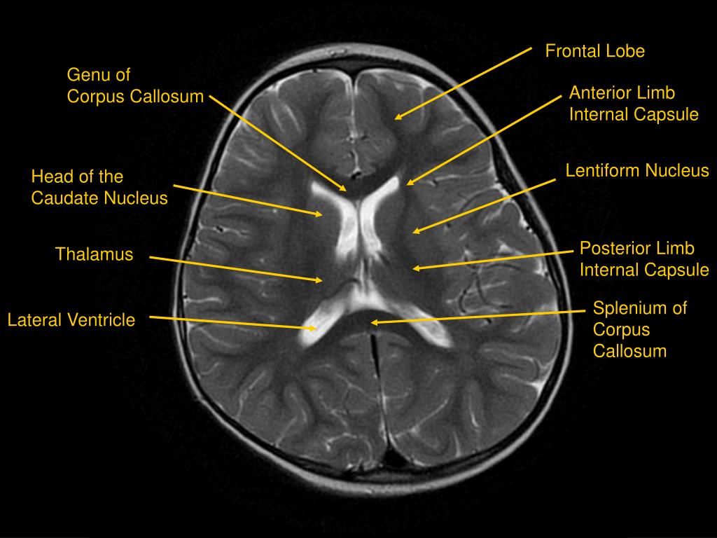 PPT MRI of Brain/Head and Neck PowerPoint Presentation, free download