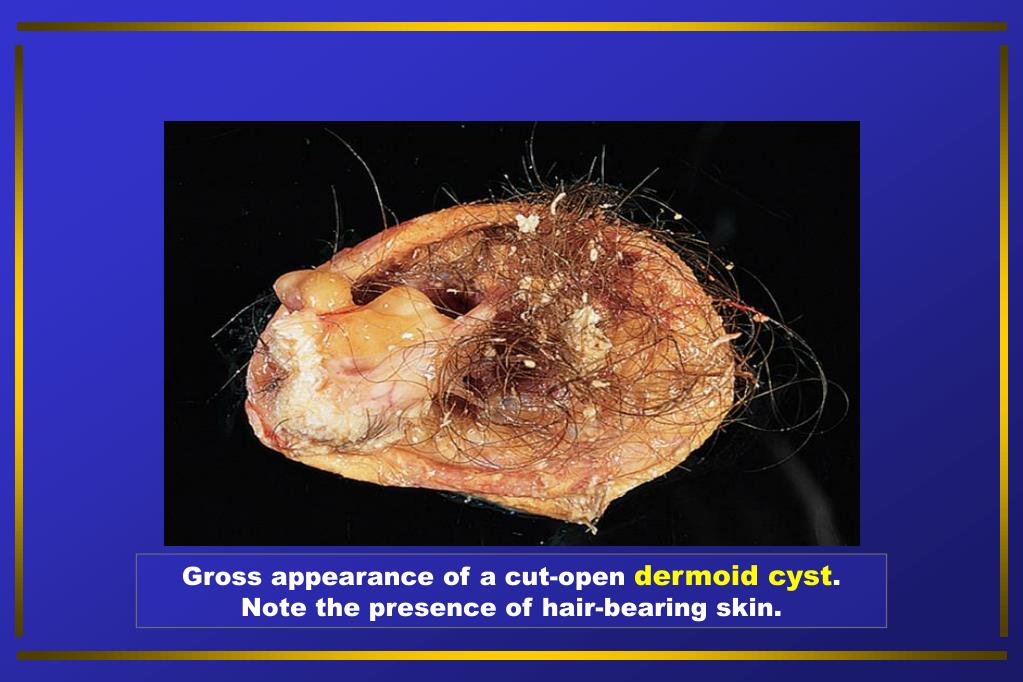 PPT Benign Diseases of the Ovary PowerPoint Presentation