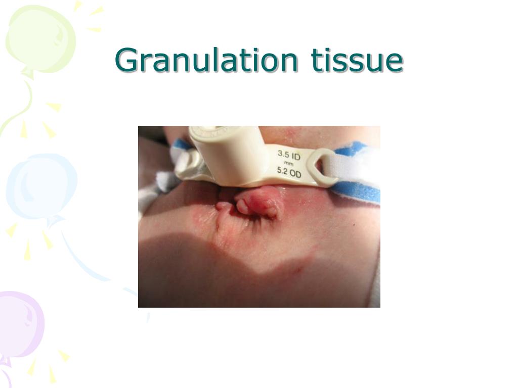 PPT Care of Tracheostomy site PowerPoint Presentation ID625422