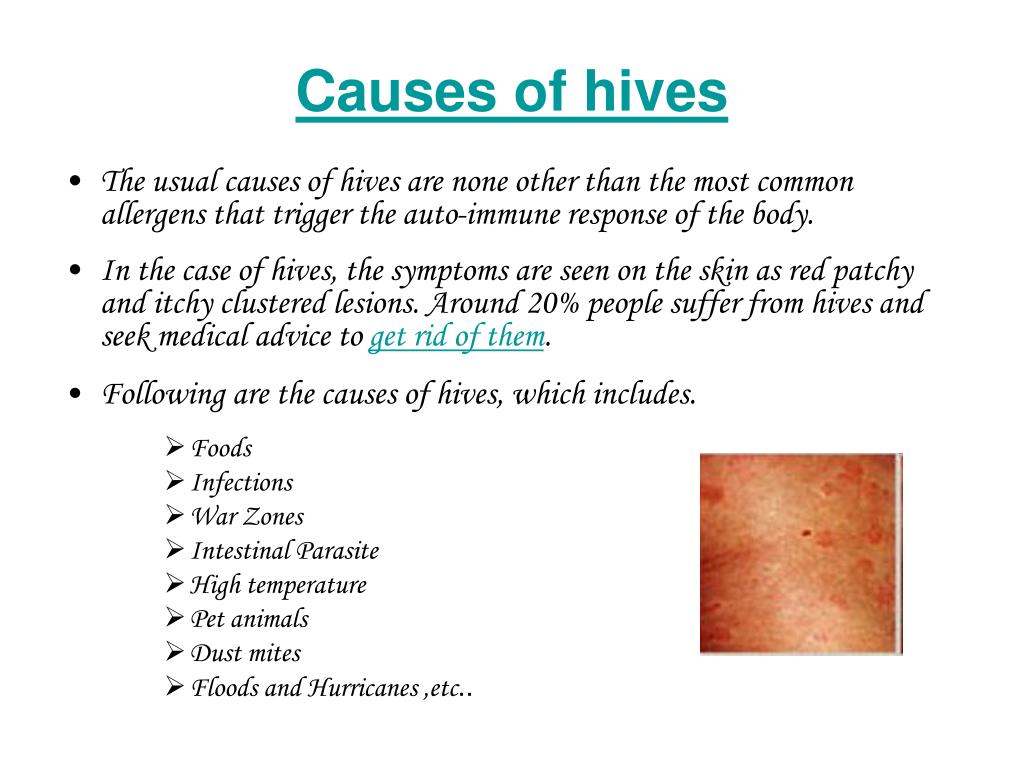 Hives Urticaria Causes Facts Types Symptoms
