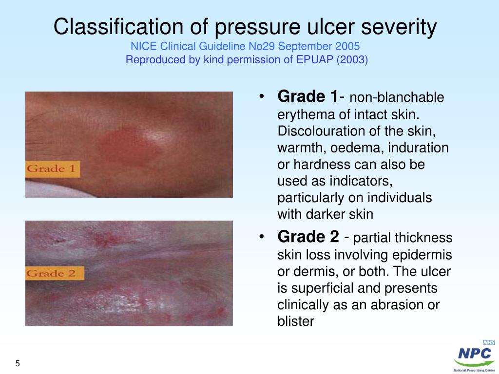 PPT Pressure ulcers PowerPoint Presentation ID637307