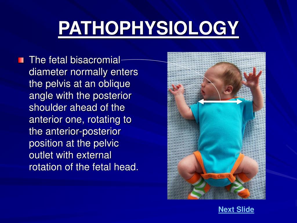 PPT Fun with Shoulder Dystocia PowerPoint Presentation, free download