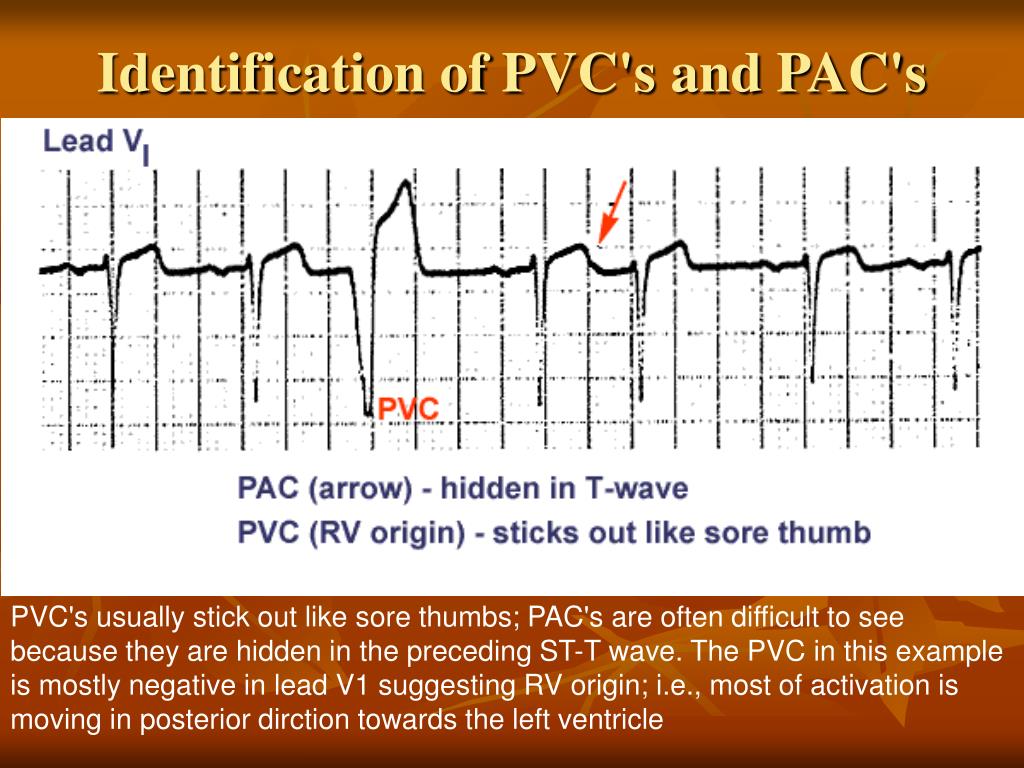 PPT ELECTROCARDIOGRAM PowerPoint Presentation, free download ID649219(04)