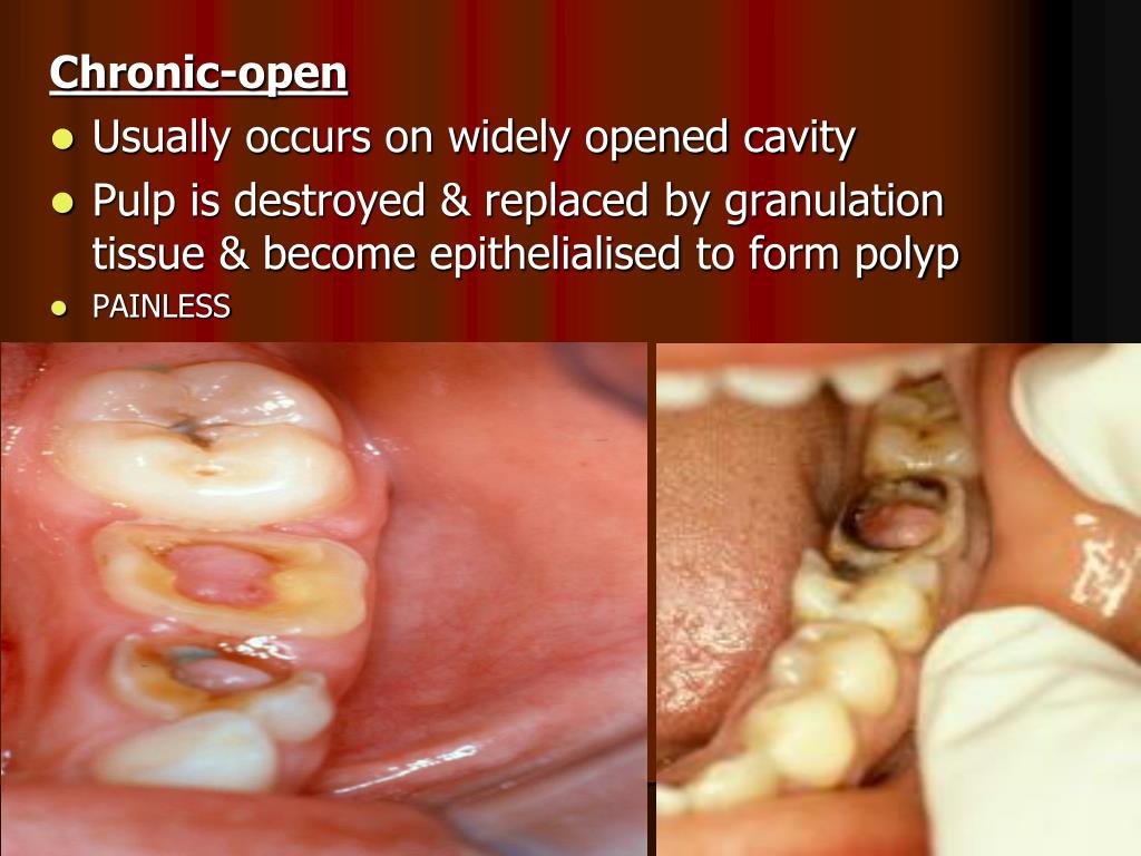 PPT PULPITIS Inflammation of dental pulp Main source for