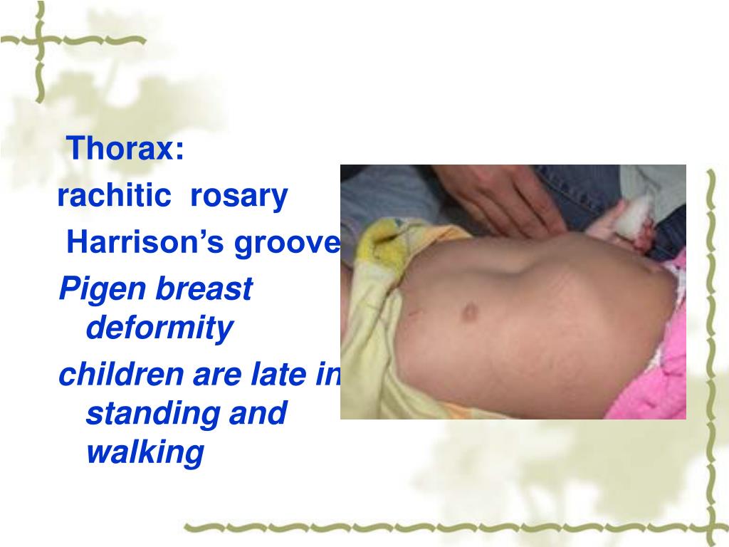PPT Rickets of Vitamin D Deficiency The Second Affiliated Hospital of