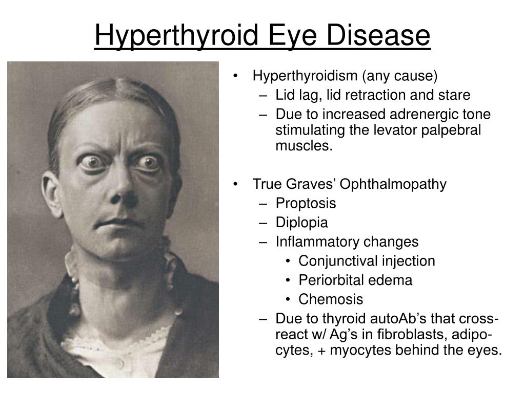 PPT Thyroid Disease Facts PowerPoint Presentation, free download ID