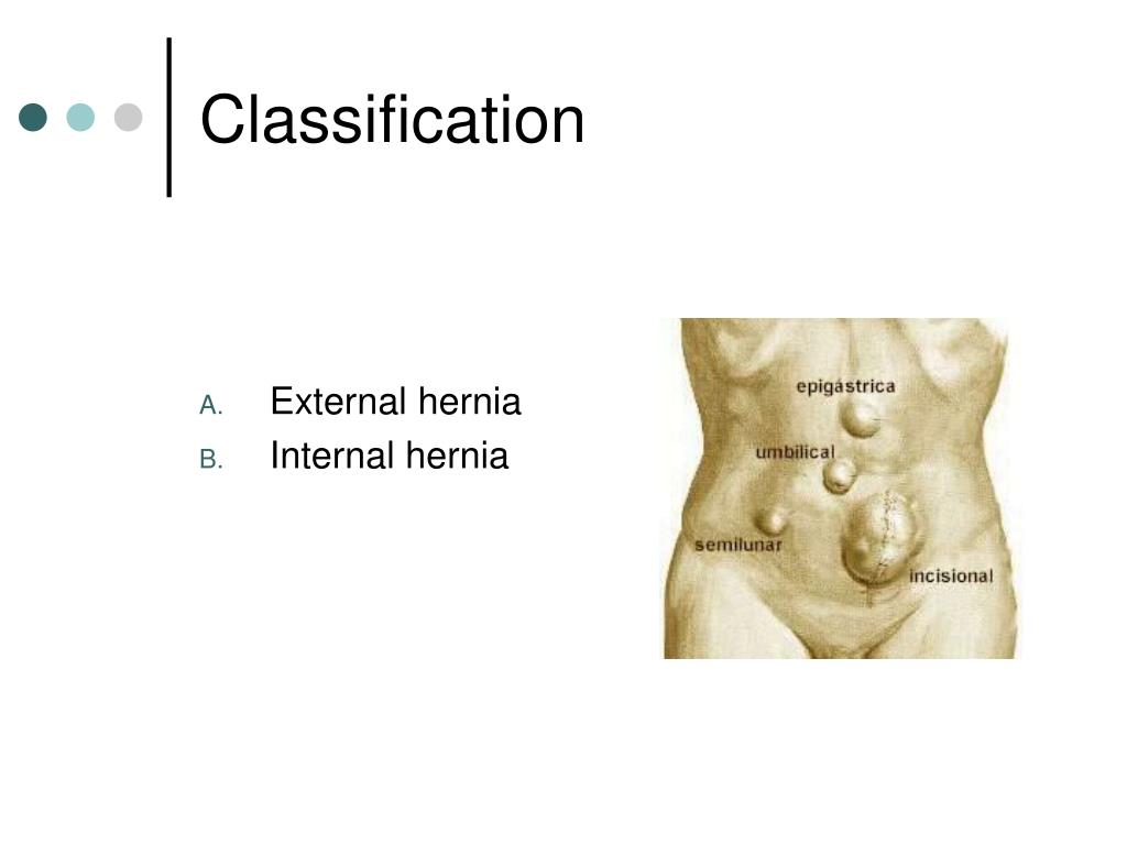 PPT HERNIAS PowerPoint Presentation, free download ID679255