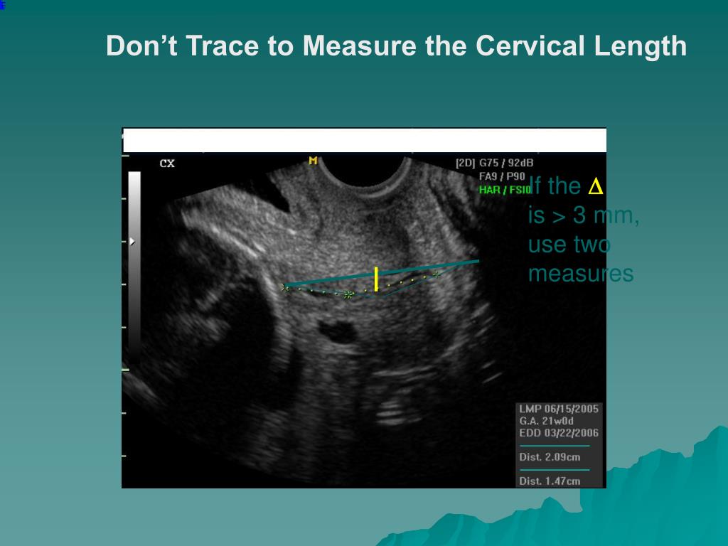 PPT Cervical Insufficiency (Cervical aka “too easy out