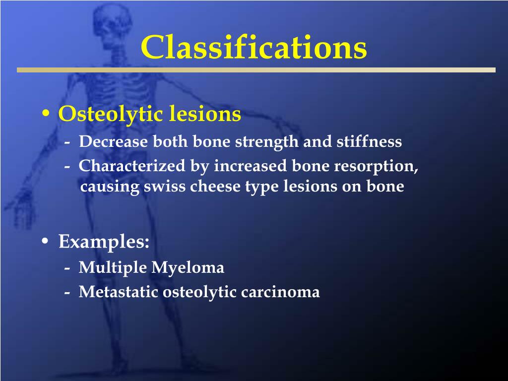 PPT Metastatic Bone Disease and Multiple Myeloma
