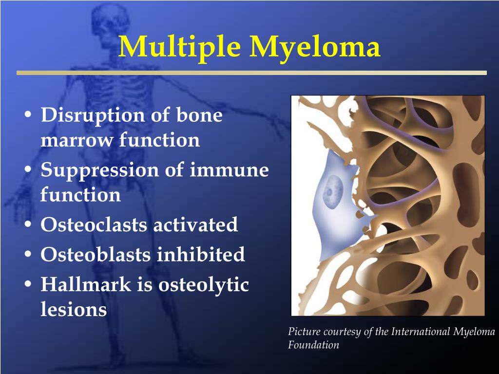PPT Metastatic Bone Disease and Multiple Myeloma PowerPoint