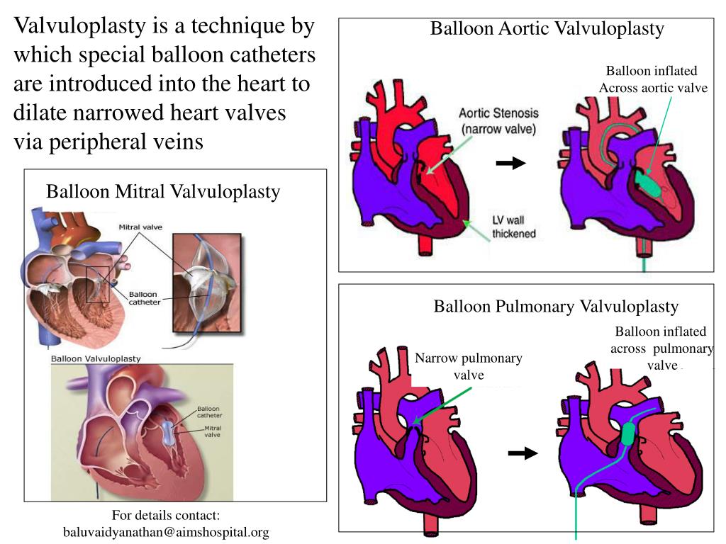 PPT Balloon Mitral Valvuloplasty PowerPoint Presentation ID687186