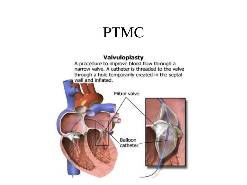 PPT Balloon Mitral Valvuloplasty PowerPoint Presentation ID687186