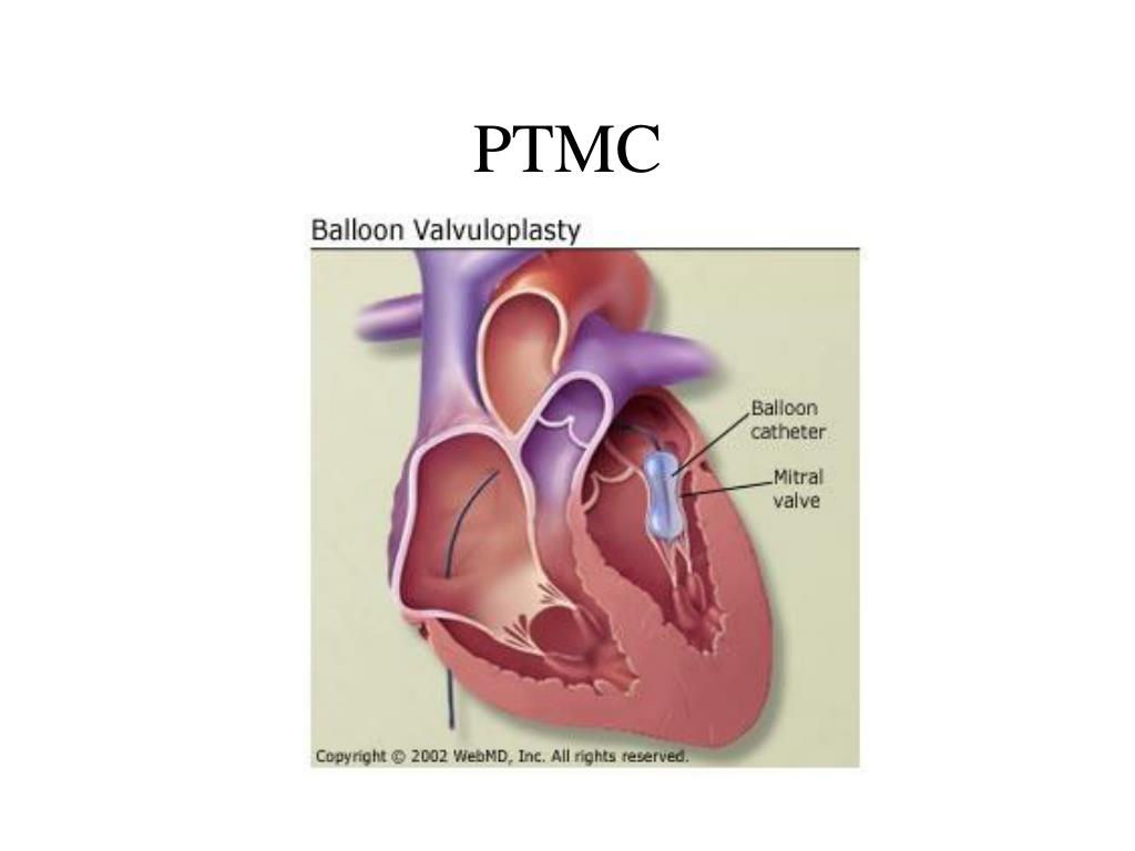 PPT Balloon Mitral Valvuloplasty PowerPoint Presentation, free