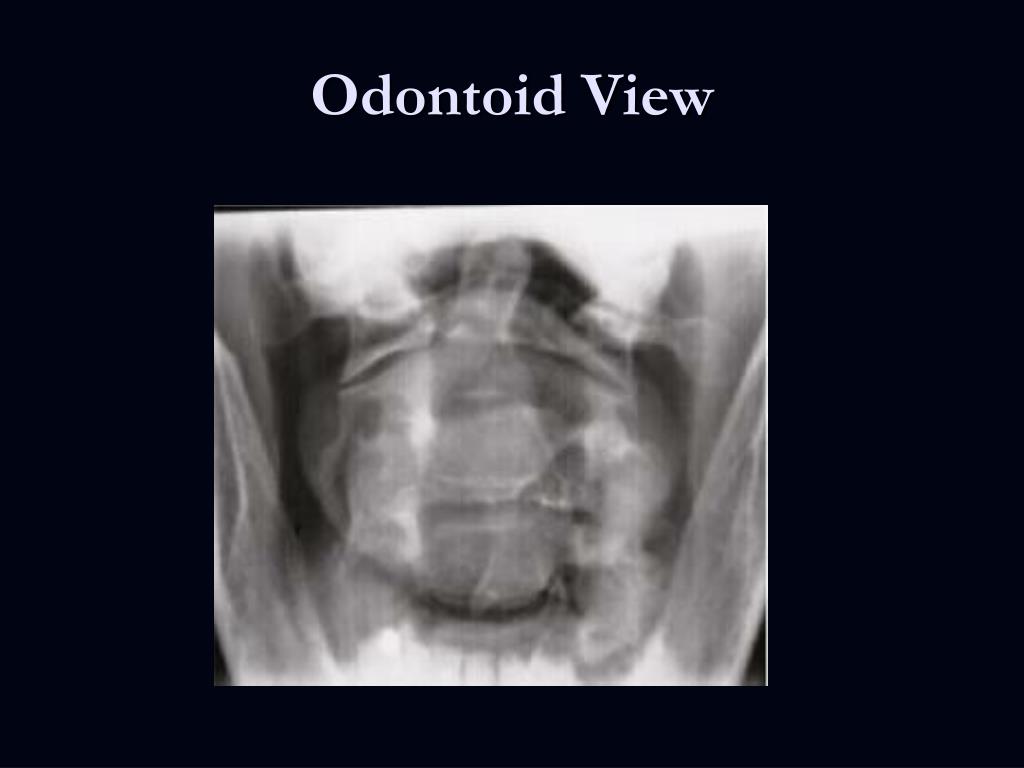 PPT Traumatic Spine and Spinal Cord Injuries PowerPoint Presentation