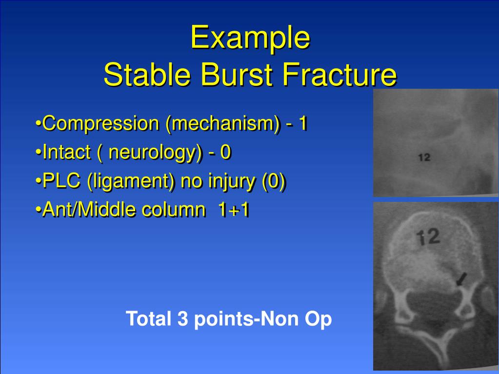 PPT Spine Trauma Study Group Thoracolumbar Classification System
