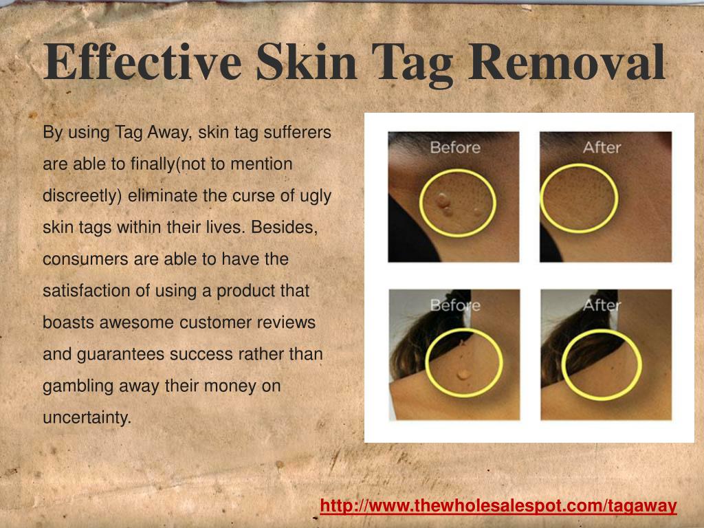 PPT Purchase Tag Away and Remove Skin Tags Painlessly at Home PowerPoint Presentation ID705820