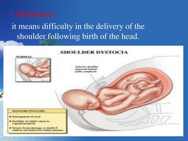 PPT Shoulder dystocia PowerPoint Presentation ID709349