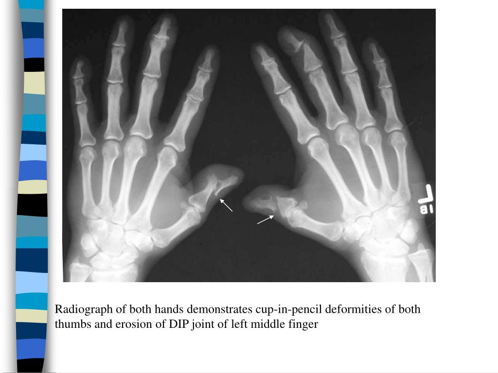 PPT Psoriatic Arthritis PowerPoint Presentation, free download ID71148