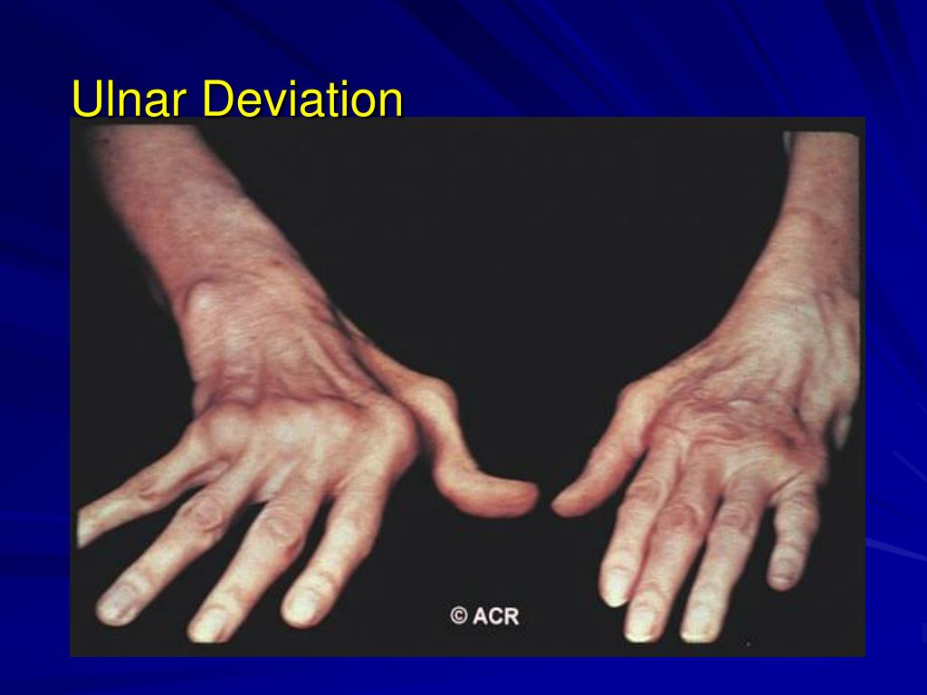 PPT Rheumatoid Arthritis 11/05 PowerPoint Presentation ID71171