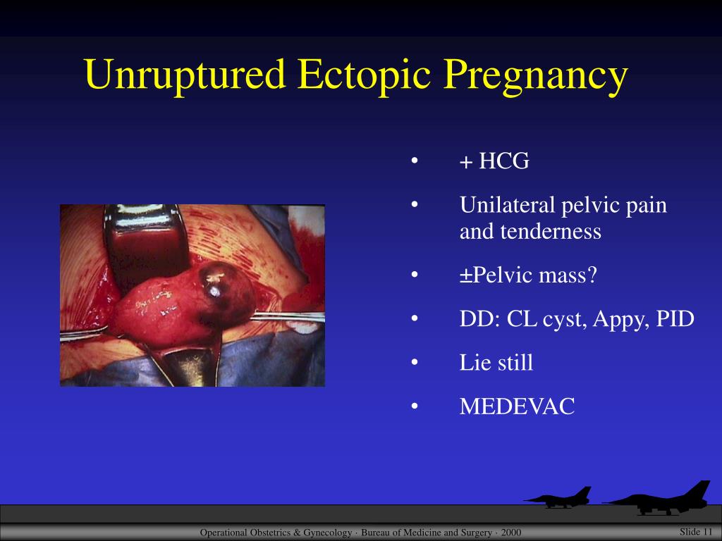 PPT Abnormal Pregnancy PowerPoint Presentation, free download ID716273