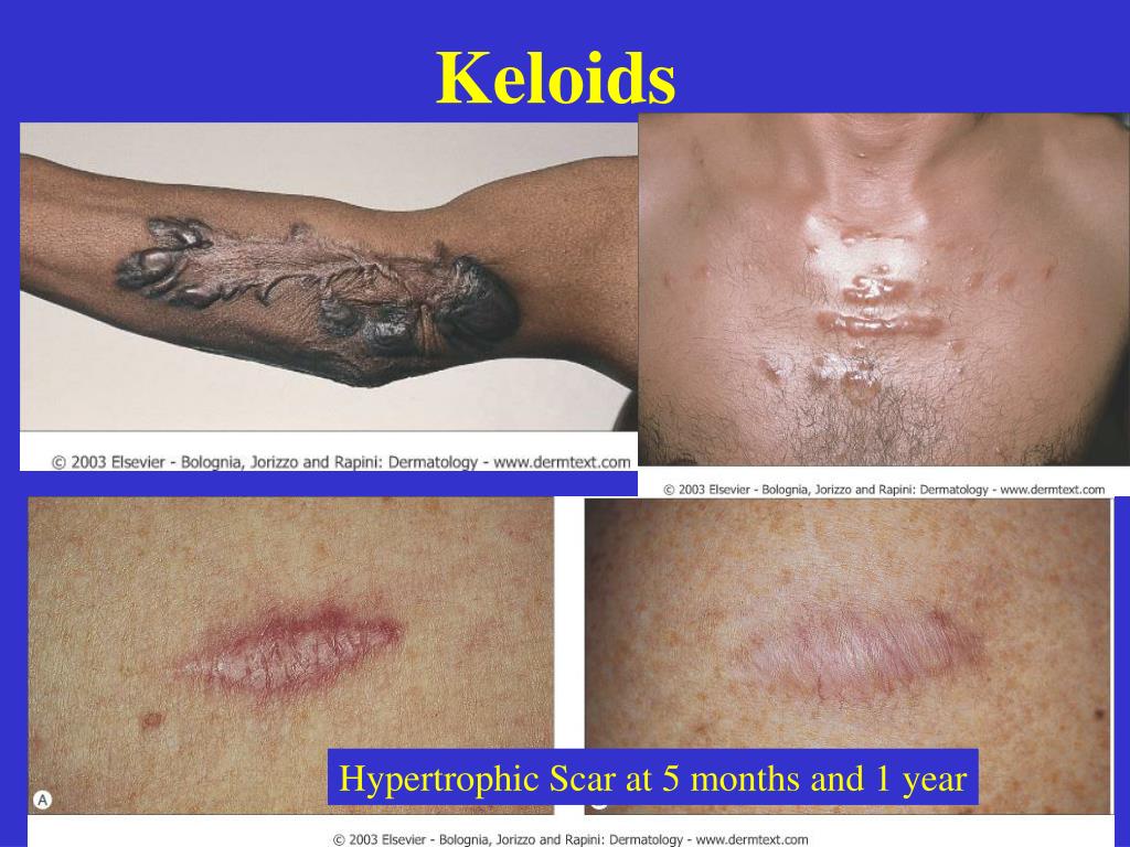 PPT Dermal and Subcutaneous Tumors Part II PowerPoint Presentation