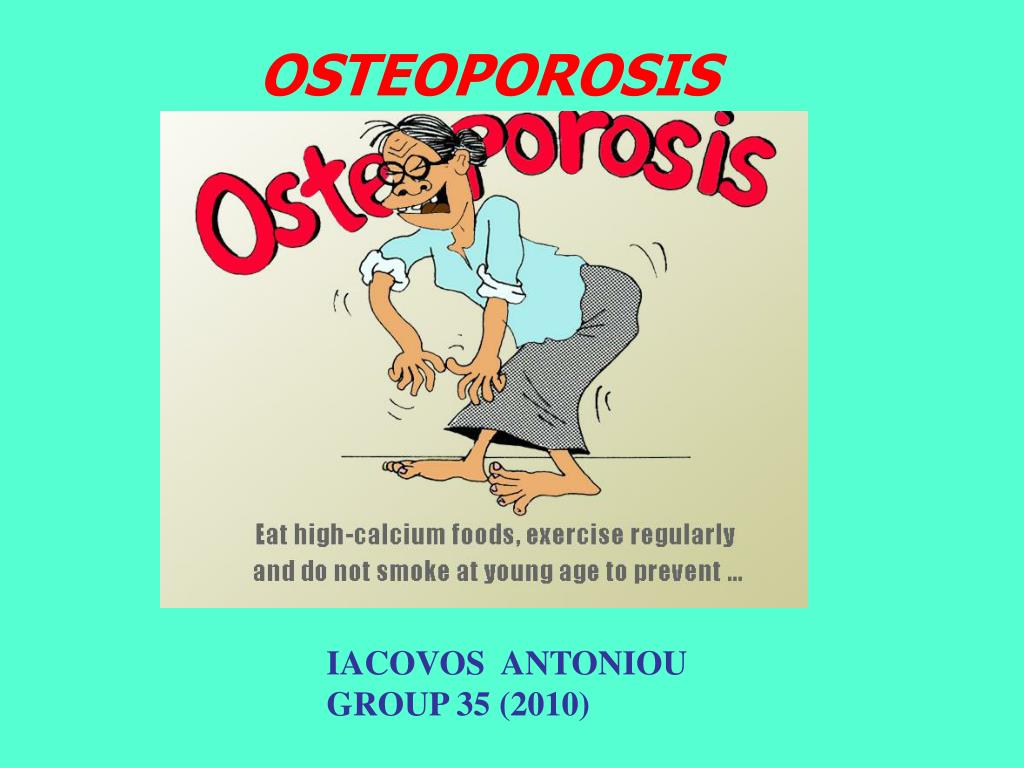 PPT OSTEOPOROSIS PowerPoint Presentation, free download ID728178