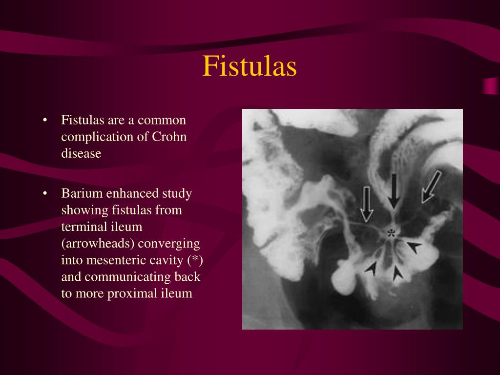 PPT Radiographic findings in Ulcerative Colitis and Crohn Disease