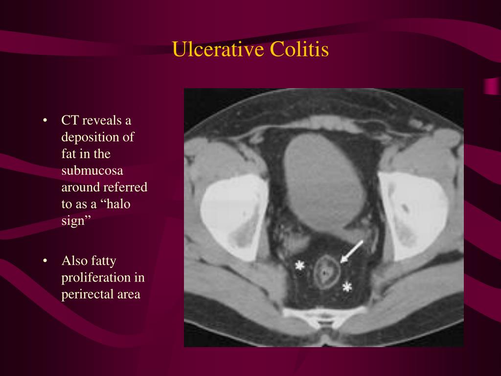 PPT Radiographic findings in Ulcerative Colitis and Crohn Disease