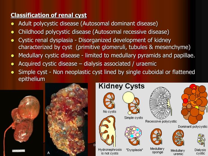 PPT - CYSTIC DISEASE OF KIDNEY PowerPoint Presentation - ID:734036