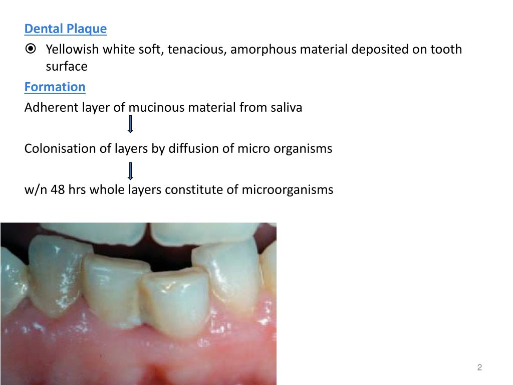 PPT DENTAL PLAQUE PowerPoint Presentation, free download ID734250