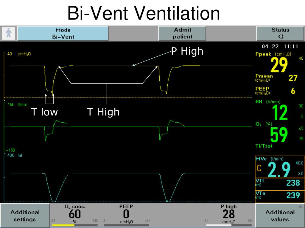 PPT Neonatal Ventilation “The Bivent” PowerPoint Presentation, free