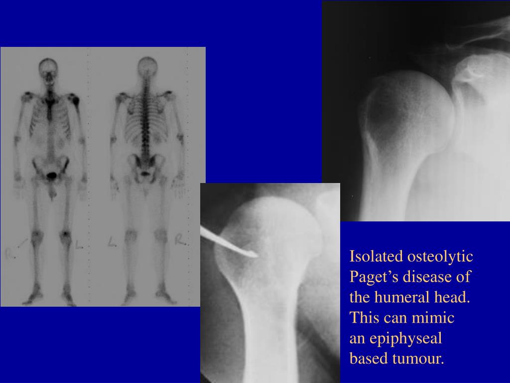 PPT The Many Faces of Paget's Disease of Bone and Its Complications as Demonstrated by Nuclear
