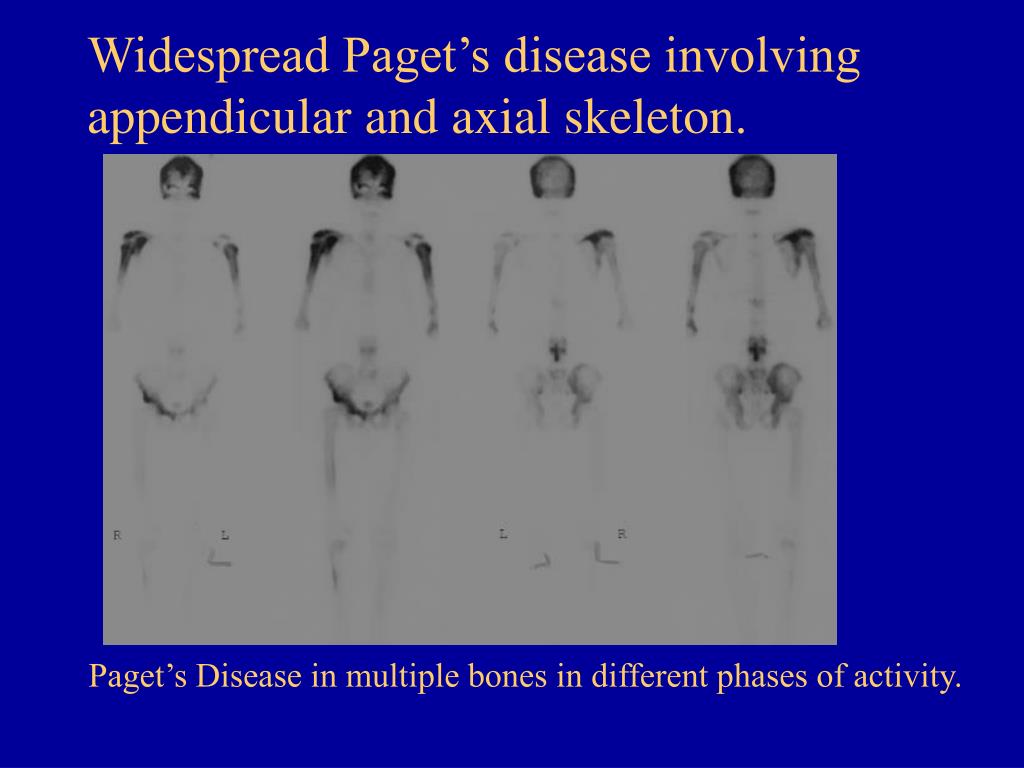 PPT The Many Faces of Paget's Disease of Bone and Its Complications as Demonstrated by Nuclear