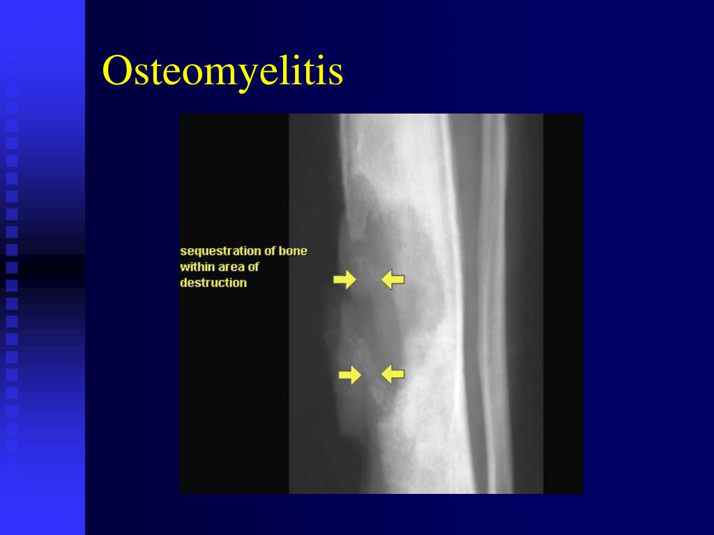 PPT SKELETAL RADIOLOGY dr. H.Undang Ruhimat,SpRad PowerPoint