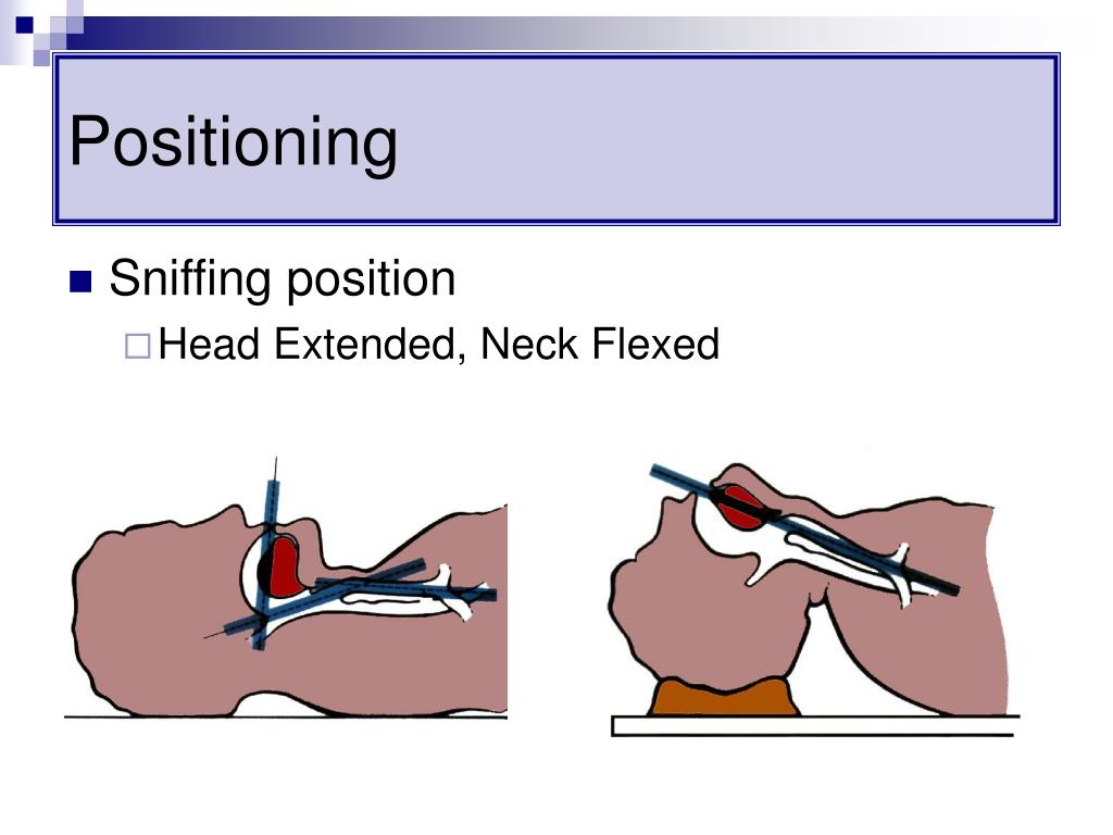 PPT Airway Management in the Critically Ill PowerPoint Presentation