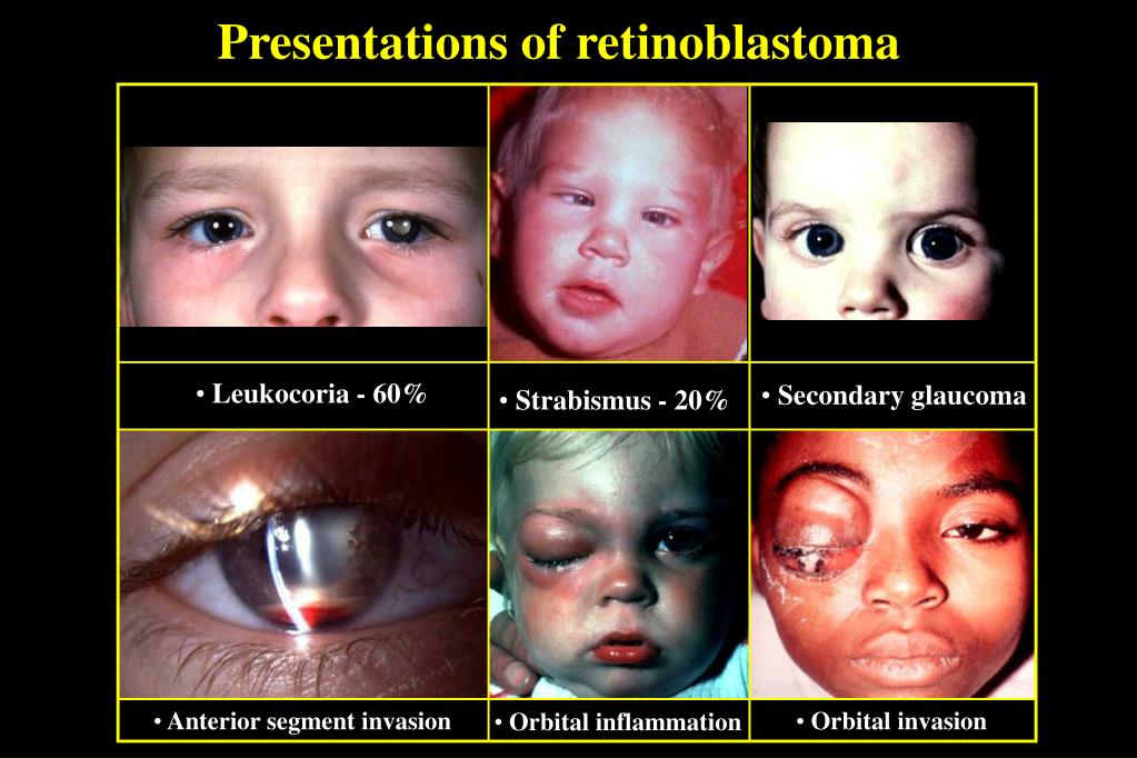 PPT RETINOBLASTOMA PowerPoint Presentation, free download ID753796