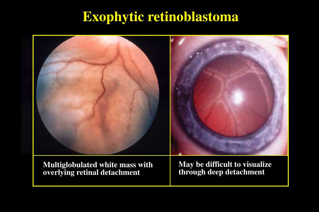 PPT RETINOBLASTOMA PowerPoint Presentation, free download ID753796